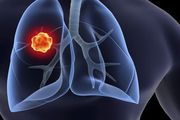 體檢查出肺結節怎麼辦？專家告訴你 5 句大實話