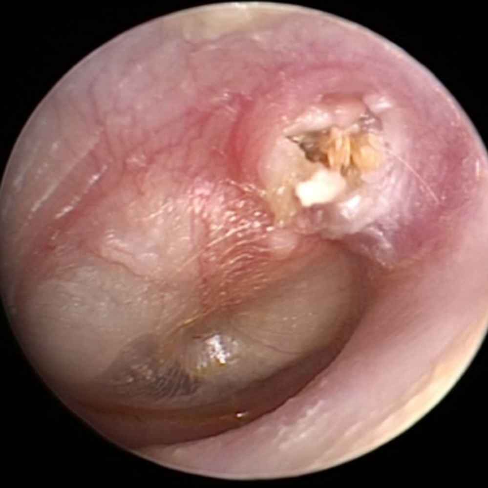 中耳膽脂瘤