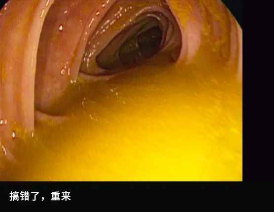 先來看看腸道內部正常的樣子