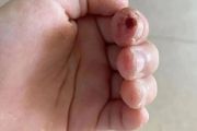「啃手指」竟導致9歲女孩要「刮骨療毒」！這個習慣趕緊戒掉！