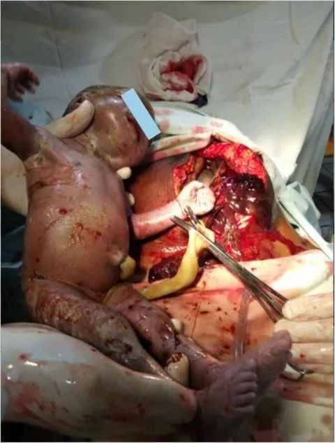 （圖片：胎兒從腹腔娩出；來源：參考文獻