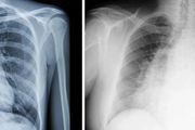 白肺是什麼？什麼情形下需要拍 CT？