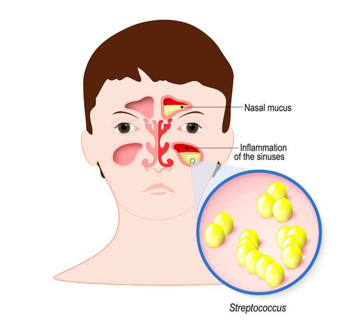 鼻竇炎的最常見、最主要的病因