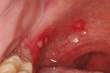 1）咽喉部潰瘍（成人）