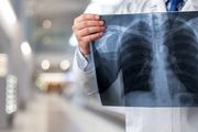 聽說出現了很多「大白肺」，感染新冠病毒，都需要做胸部CT檢查嗎？