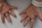 孩子手指伸不直、大拇指握在手掌？注意扳機指和拇指內扣