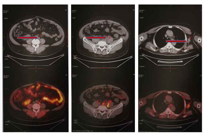 圖2 患者PSMA-PET/CT結果