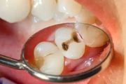 這 5 個保護牙齒的方法一定要記住