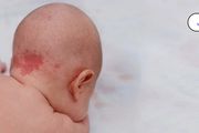 嬰兒的紅色胎記是血管瘤嗎？3 個方法辨別，一張表判斷嚴重性