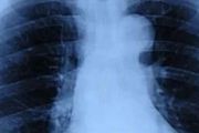 什麼是「白肺」，如何防範？（老年人需要重點關注）